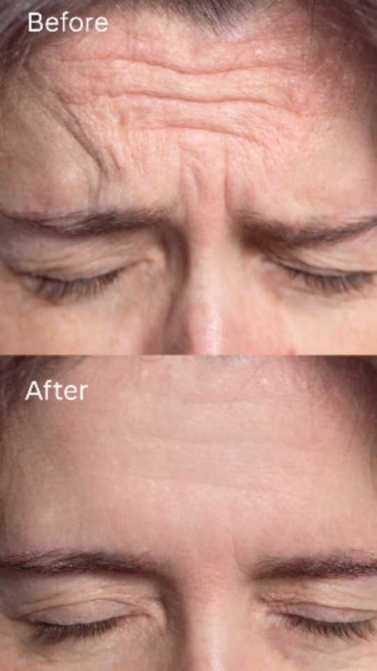 Before and after