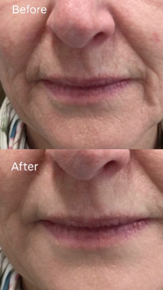 Before and after